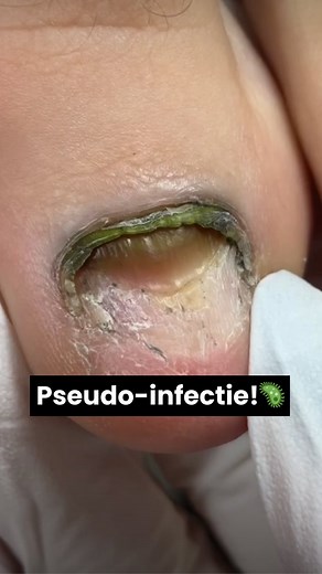 Deel 1: Een mini-kijk in hoe ik deze pseudonoma infectie opzuiverde. 🦠 Op zoek naar een link voor alle materialen en producten die ik hier gebruik? Klik hieronder!👇🏽 | The Pedi school