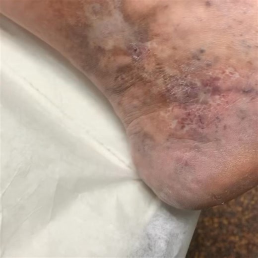 This patient has all the subtypes of complicated venous disease: What are the subtypes of venous disease ? Stage 1 - spider veins Stage 2 - varicose veins Stage 3 - swelling Stage 4 - bronzing of the skin Stage 4a - venous stasis dermatitis (rash) Stage 4 b - lipodermatosclerosis Stage 4c - corona phlebectatica Stage 5. - healed venous ulcer Stage 6. - active venous ulcer Stage 6r - recurrent venous ulcer If you are stage 2 or above, make an appointment for evaluation and treatment . @veintreatm