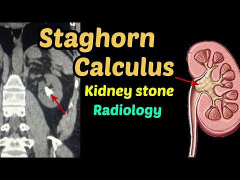 Kidney stone Staghorn calculus | coral calculi |CT Scan Radiology