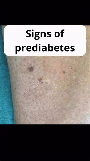 Taking care of gut health can help prevent diabetes, especially type 2. A healthy gut is linked to better blood sugar regulation and improved insulin sensitivity. Here are some ways this happens: Balanced Diet: A diet rich in fiber, fruits, vegetables, whole grains, and probiotics can improve gut health and help control blood sugar levels. Gut Microbiome: The diversity of bacteria in the gut plays a crucial role in nutrient metabolism and glucose regulation. A balanced gut microbiota may help pr