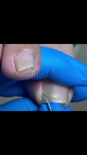 Silky smooth removal of embedded armor! #foot #satisfying