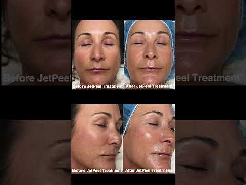 Watch a JetPeel Facial from our Medical Aesthetician, Farzaneh Momeni