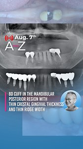 BD Cuff in the mandibular posterior region with thin crestal gingival...
