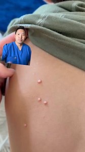So common but a pain in the butt to deal with these pesky bumps that can linger for over a year! #stitch @officialracheljames #MolluscumContagiosum #MolluscumRemoval #PoolWarts #MolluscumTreatment #MysteryRash | Daniel Sugai, MD, FAAD