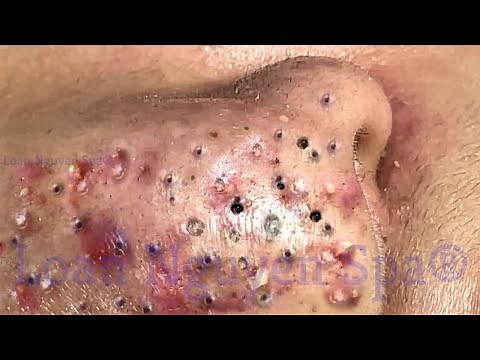 Blackhead Removal With Sac Dep Spa @100074666