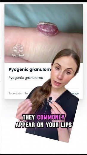 What Is Growing On Her Lip? #dermatologist