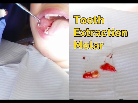 Tooth Extraction Procedure ( Graphic )