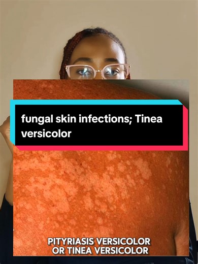 Understanding Tinea Versicolor: Causes and Treatments
