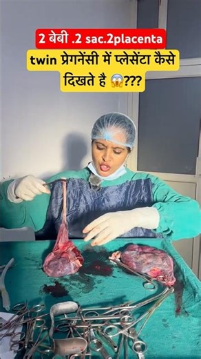 What does placenta look like in twin pregnancy 😱???2baby,2sac,2placenta #viral #trending #ytshort...