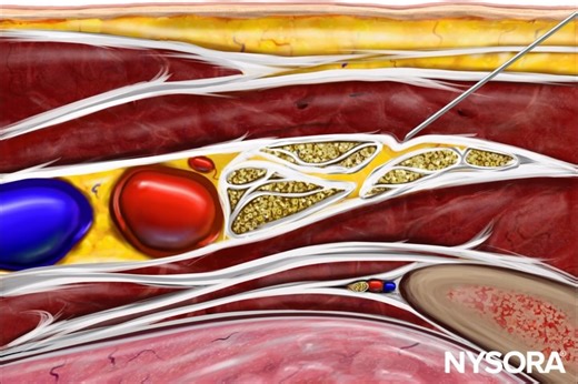 NYSORA Inc. on Instagram: "Just added to the NYSORA Nerve Blocks App! Watch the newest animation of the costoclavicular brachial plexus block! Follow the detailed technique, from precise needle placement to local anesthetic distribution. Ideal for refining your skills or teaching regional anesthesia techniques. Begin your learning journey—download the Nerve Blocks app now! The link is in the bio!"