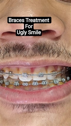 Braces Treatment for Ugly Smile