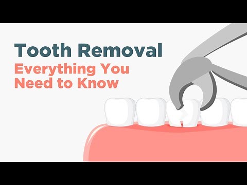 Surgically Removing a Tooth - Everything You Need to Know
