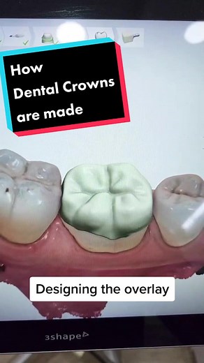 Digital Workflow for CAD-CAM Crowns in Dentistry