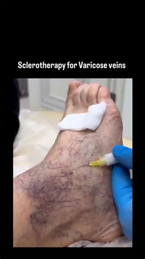 @medico_ahm on Instagram: "Sclerotherapy is a highly effective, minimally invasive, non-surgical outpatient procedure that treats varicose and spider veins by injecting a solution directly into the vessel, causing it to collapse and fade, usually in 30–45 minutes. It reduces pain, swelling, and improves appearance with fast recovery and minimal side effects, such as temporary bruising or redness. Key Aspects of Sclerotherapy: Procedure: A sclerosant agent (liquid or foam) is injected, irritating