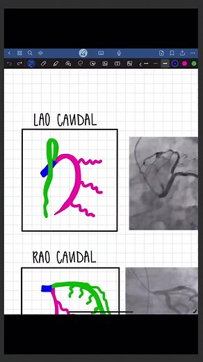 Coronary Angiograms and Views! Diving into LAO Caudal vs RAO Caudal. Watch my previous video for the cranial views! #cardiaccare #cathlabtips #rcis #radtech #medicineexplained #cathlab #medicalstudent #nursepractitioner #physicianassistant #cardiac #cardiology