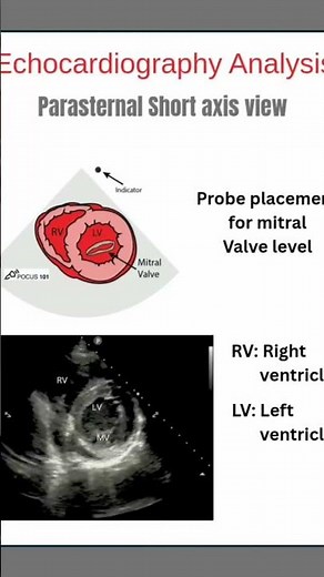PSAX view showing normal LV contraction and wall motion.”