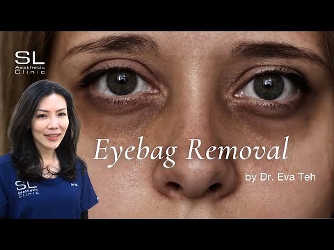 Non-Surgical Eye Bag Removal l SmoothEye™ Pro Laser, Undereye & Tear Troughs Fillers