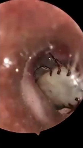 A 5yrs Old male, Got Dog Tick in his ear for two weeks. RR ENT team removed it successfully