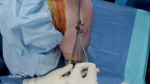 Anterolateral Ligament Reconstruction Using Knotless Knee FiberTak® Anchors