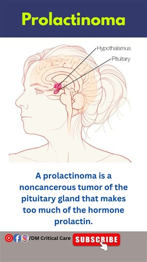 Prolactinoma|Non-cancerous Tumor of the Pituitary Gland|DM Critical Care #prolactinoma #ytshorts