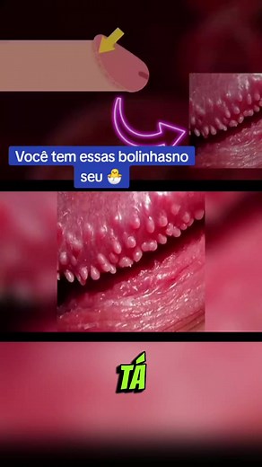 Glândulas de Tyson: O que são e como tratar