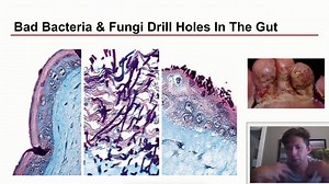 Do you know what Leaky Gut is? . Nobody knows the true cause and cure of it! . . So in this video, I am going to share with you everything that you need to know about Leaky Gut. . . Let's dive right in! . . . BONUS OFFER!!! . Save your precious Health, Time, Energy and Money from dangerous medications and holistic remedies that don't work. . Download our “21 Nutrition and Health Lies Keeping You Sick” ebook now for FREE! - http://ow.ly/ZU8e50qIsdA #Crohns #LeakyGut #Colitis #IBS #IBD #Candida #G