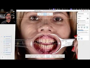 Diseño de sonrisa digital en la práctica: paso a paso con Medit Smile Design