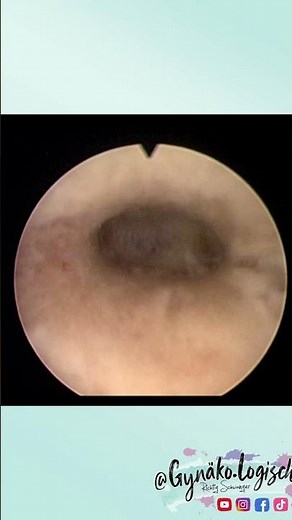 Gynecologic Examination Of The Uterine Cavity