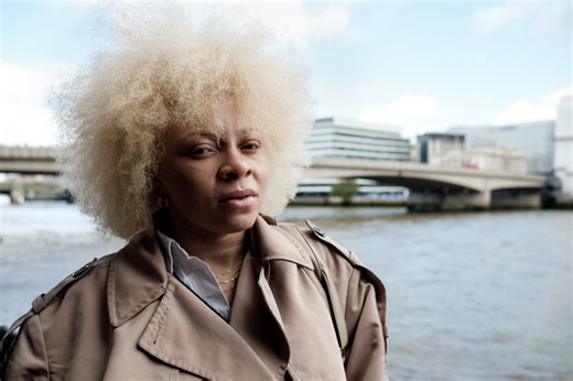 Being Black With Albinism: Challenging Beauty Norms & Stereotypes