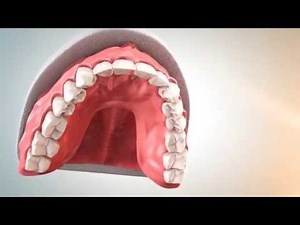 Dental Implant Maxillary Overdenture