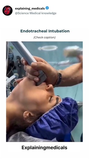 Endotracheal Intubation: Life-SavingAirway Procedure...😷🫁