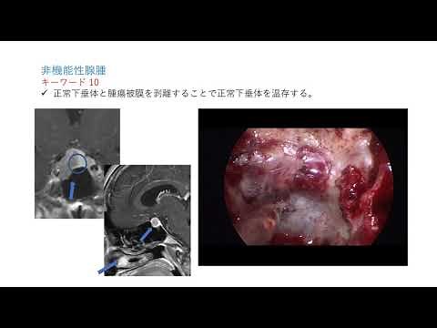 キーワードでわかる間脳下垂体腫瘍