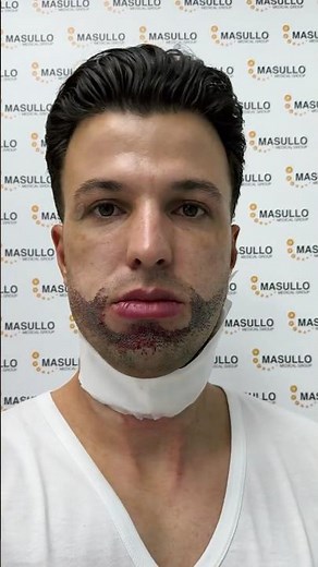 2 MONTHS POST BEARD TRANSPLANT