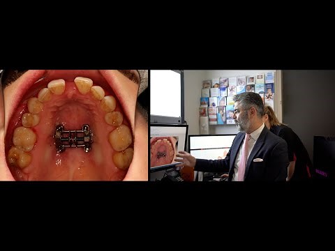 MSE expander explained by Dr Derek Mahony & Dr Isabel Drewling on an interview with Karina.