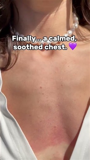 I Finally Found Something That Helped My Chest Folliculitis