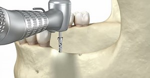 Cleavage of the alveolar ridge, augmentation, implantation. Dental surgery, 3D animation.