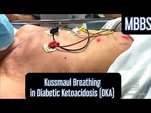 Kussmaul Breathing seen in Diabetic Ketoacidosis (DKA) #mbbs #medicine #neetpg #aiims #usmle