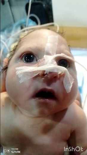 "Small Head Size Noted 👶 | Microcephaly Diagnosis in NICU #neonatologist #newbornbaby #neonatal #ne