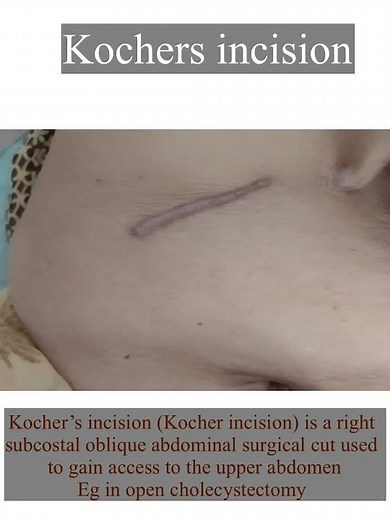 Kochers incision