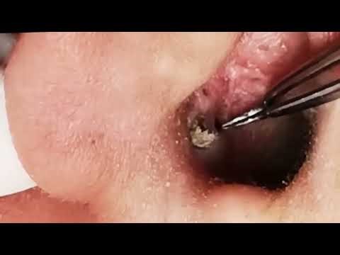 #012 Huge Earwax Extraction 😱 | Ear Insect Removal, Deep Ear Cleaning & Weird Ear Canal Objects