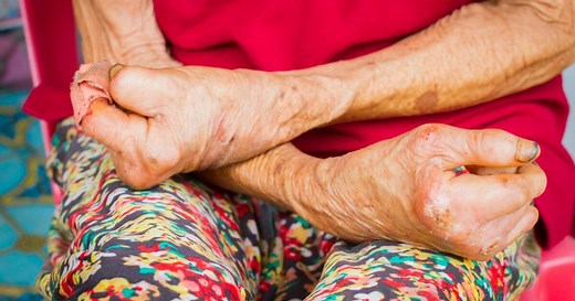 Lepra: Cómo prevenir el contagio y qué tratamiento existe