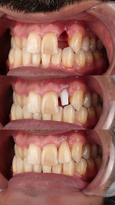 حالة تم علاجها في قسم الزراعة في عيادة ليبرتي لطب الأسنان Treated by the implant department at Liberty Dental Clinic #drmohammednaji #dentistry #dubaidentist | Dr. Mohammed Naji
