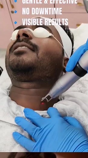 Laser Toning for Neck Pigmentation | Skin101Clinic