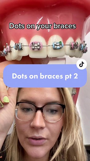 Understanding Colored Dots on Braces: Meaning and Removal Tips