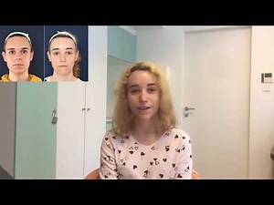 Facial Feminization Surgery Review - Felina, Dr Bart van de Ven reviews