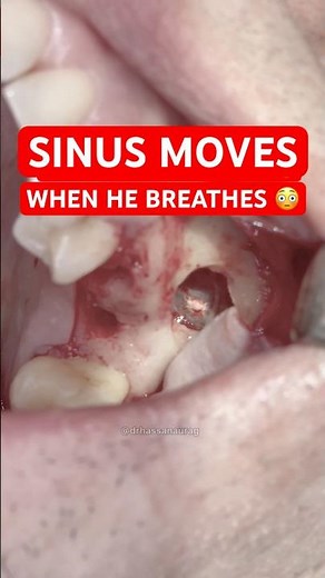 Sinus Lift & Dental Implants: Watch the Sinus Move While Breathing 😳🦷