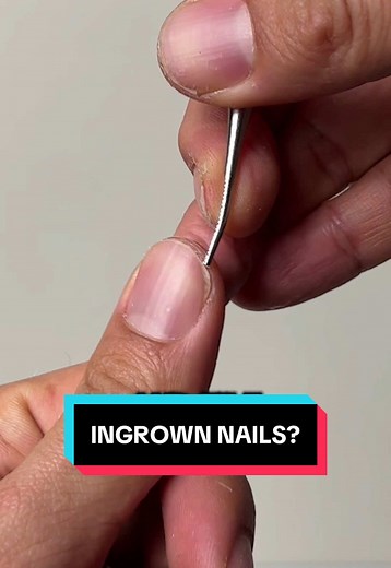 Ultimate Nail Care Kit for Ingrown Nails Relief