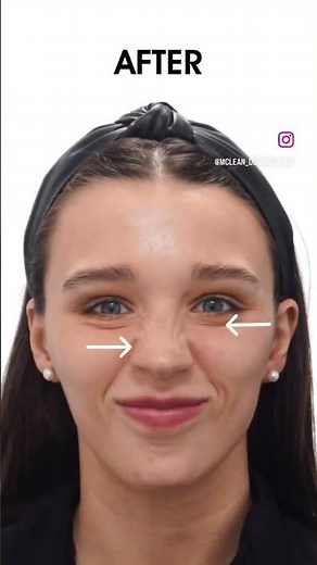 Botox Before + After #botoxtreatment #wrinklereduction #botox