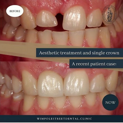 Single Crown to Replace Damaged Front Tooth | Before and After