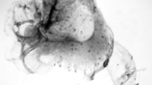 Tumor is reduced using tiny robots that attack growth with radioactive isotopes